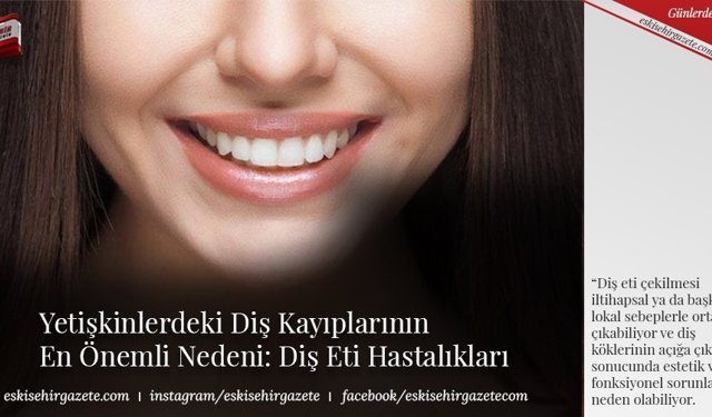 Yetişkinlerdeki Diş Kayıplarının En Önemli Nedeni: Diş Eti Hastalıkları